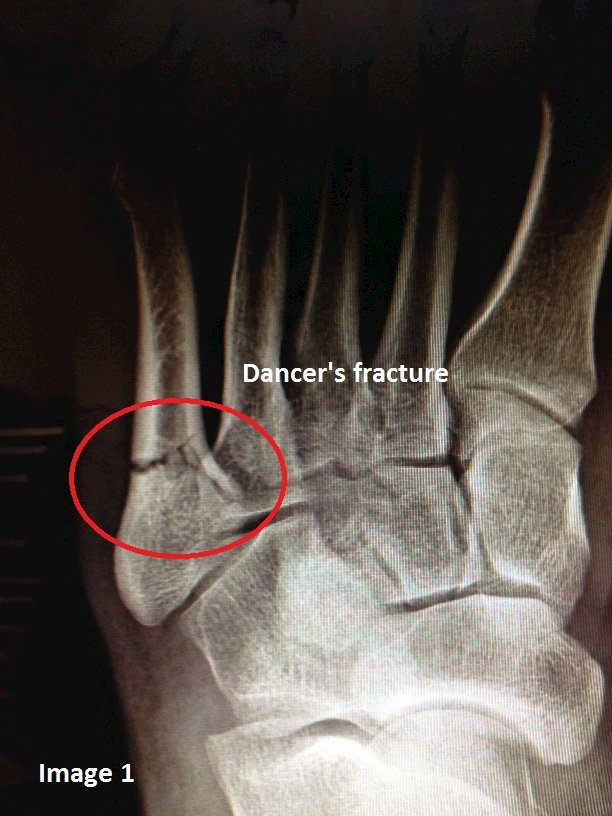 Dancer's fracture